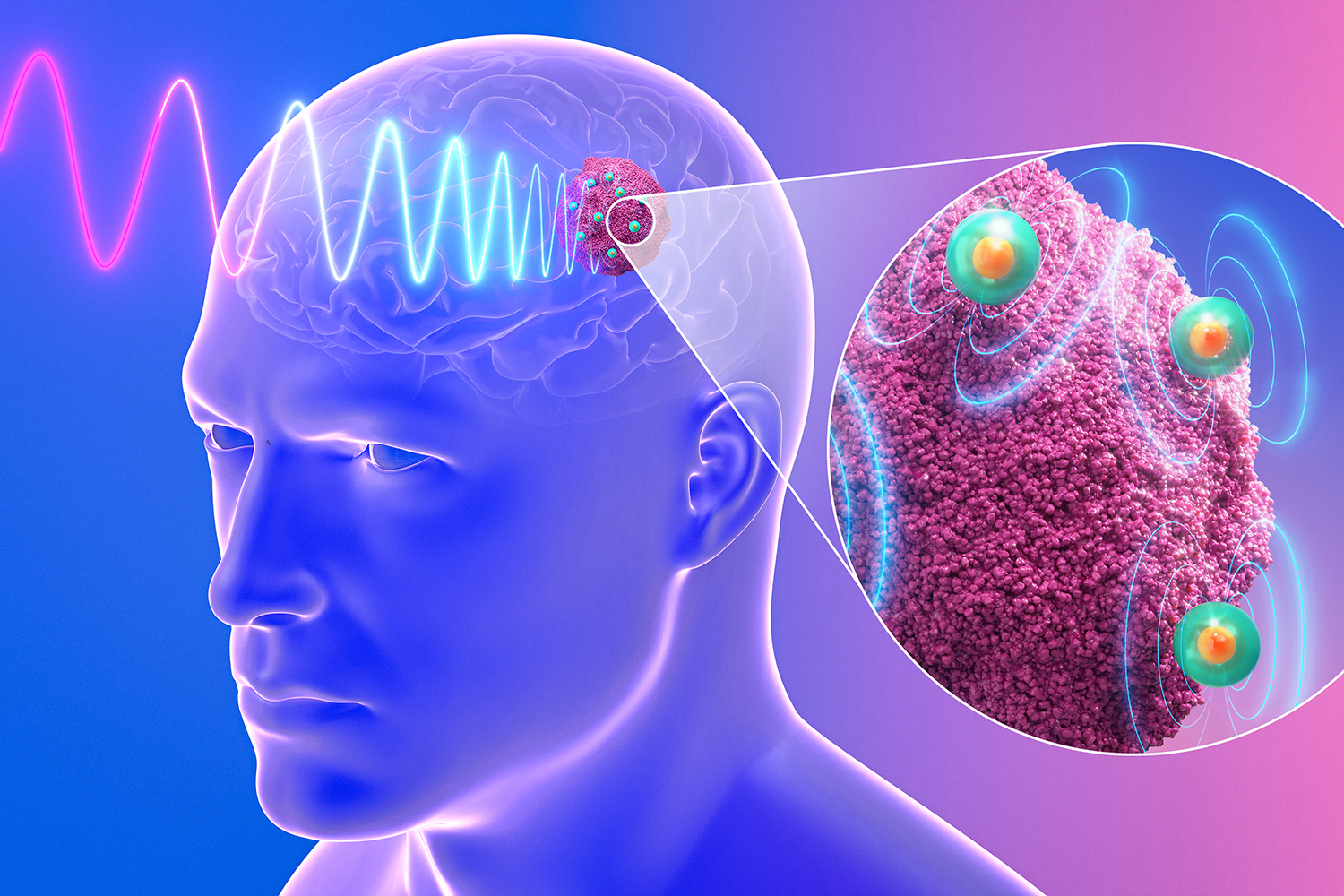 This illustration depicts injectable nanoantennas being wirelessly activated by a magnetic field to generate localized electric fields that target a brain tumor. The magnified inset shows nanoparticles interacting with drug-resistant glioblastoma tissue.
